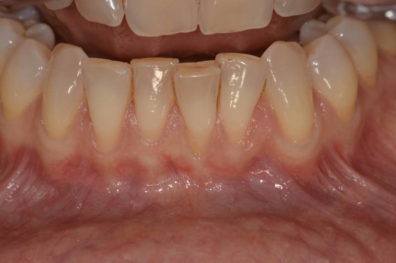 Récessions Gingivales sur les incisices inférieures